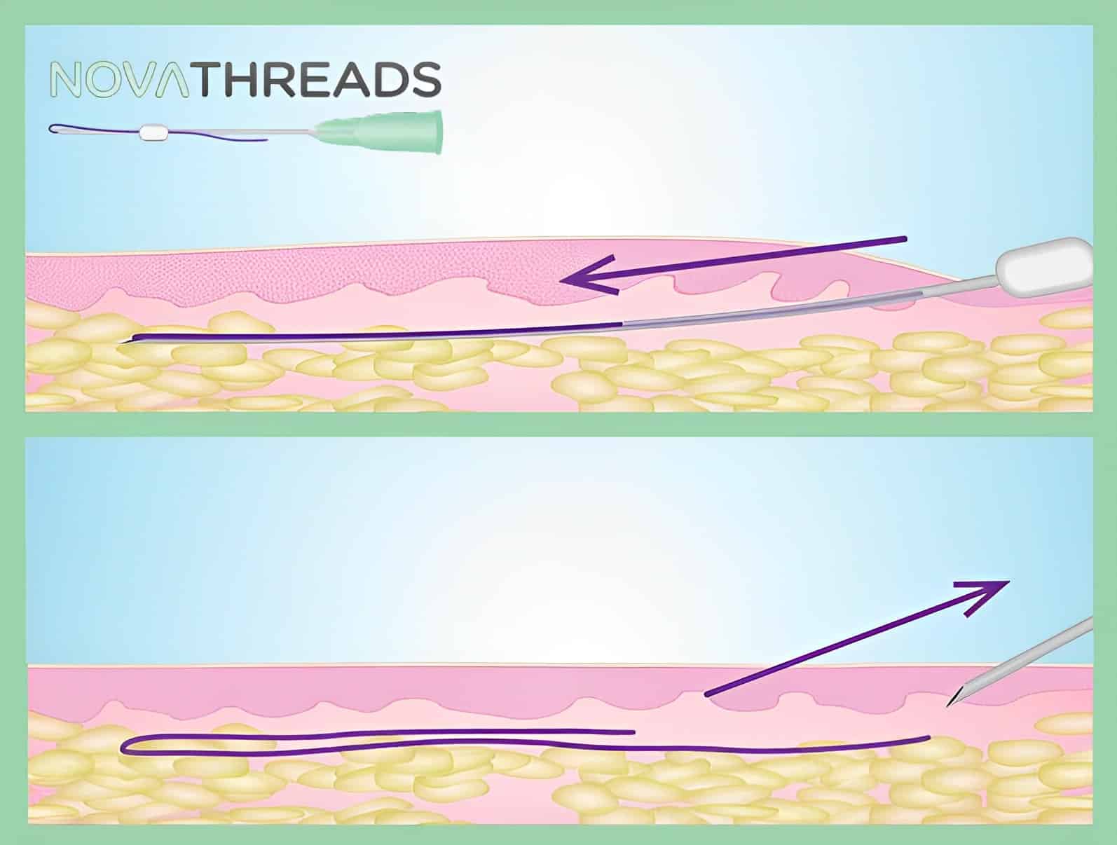 PDO THREADLIFT 1